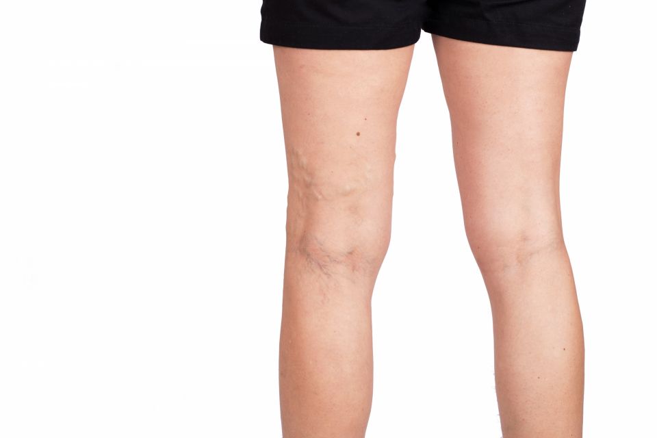 Collagen and Its Effect On Varicose Veins – Will Supplements Help?