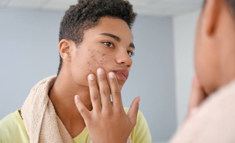 Say Goodbye to Hormonal Acne, with This Diet and Supplement Regime