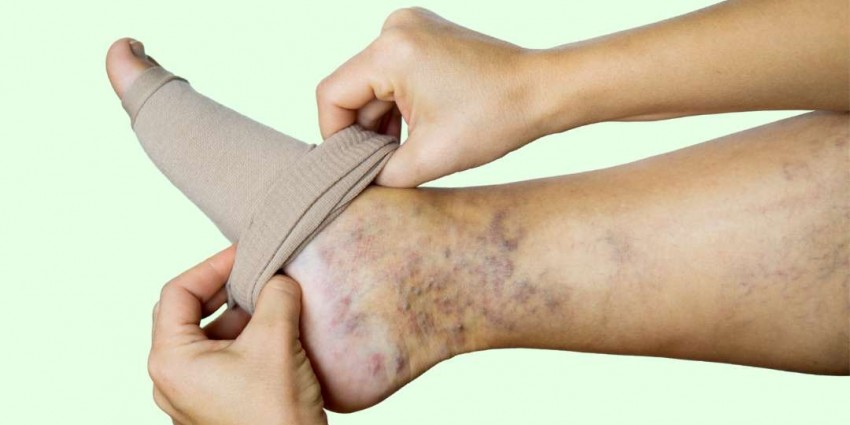 Compression Stockings